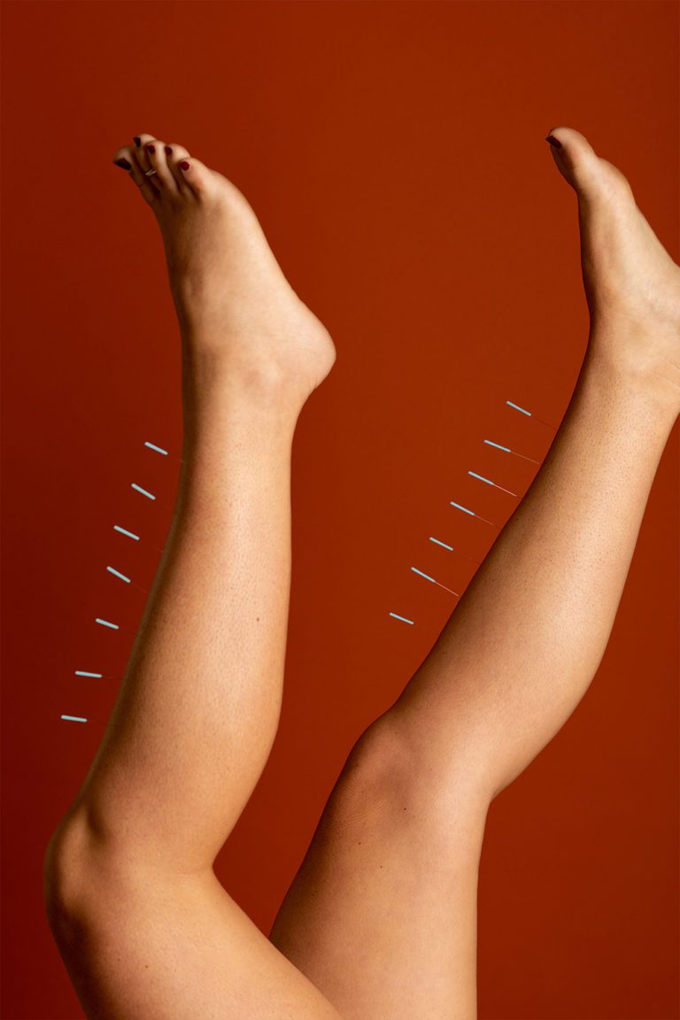 2019’s Biggest Wellness Trend: Acupuncture