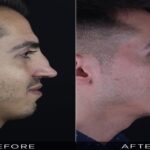Revision Rhinoplasty in Turkey Reasonable Costs Without Compromising Standard