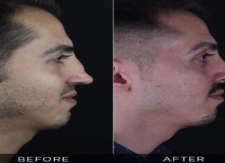 Revision Rhinoplasty in Turkey: Reasonable Costs Without Compromising Standards