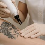 Why Renude Laser Tattoo Removal Clinic Is the Leading Choice for Tattoo Removal in Sydney
