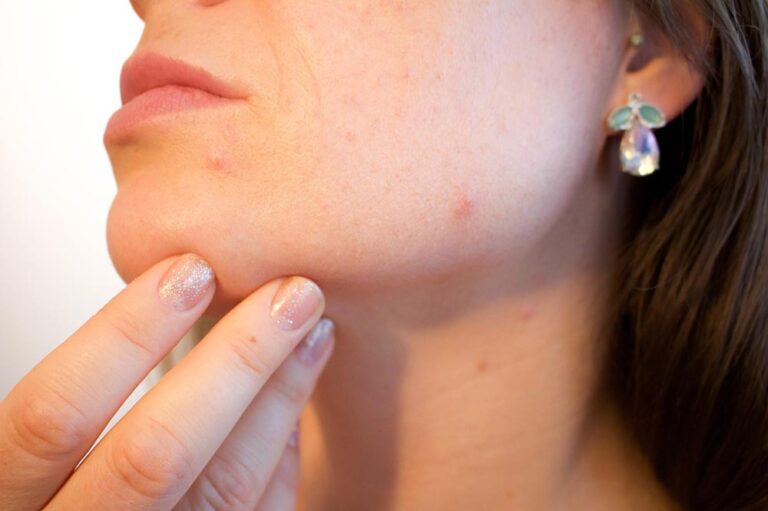 Tackling Acne Scars with Microneedling: A Mom’s Guide to Clear Skin