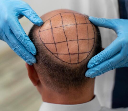 Why Choosing the Right Hairline Design Matters for Natural Results