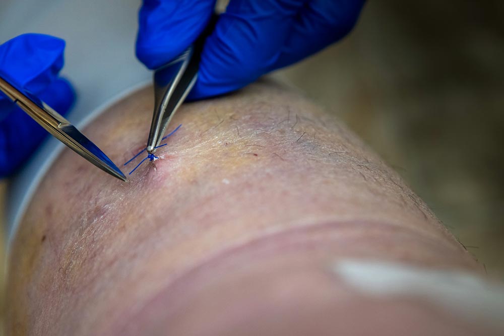 Scar Camouflage vs Stretch Mark Revision: Understanding the Right Treatment Approach